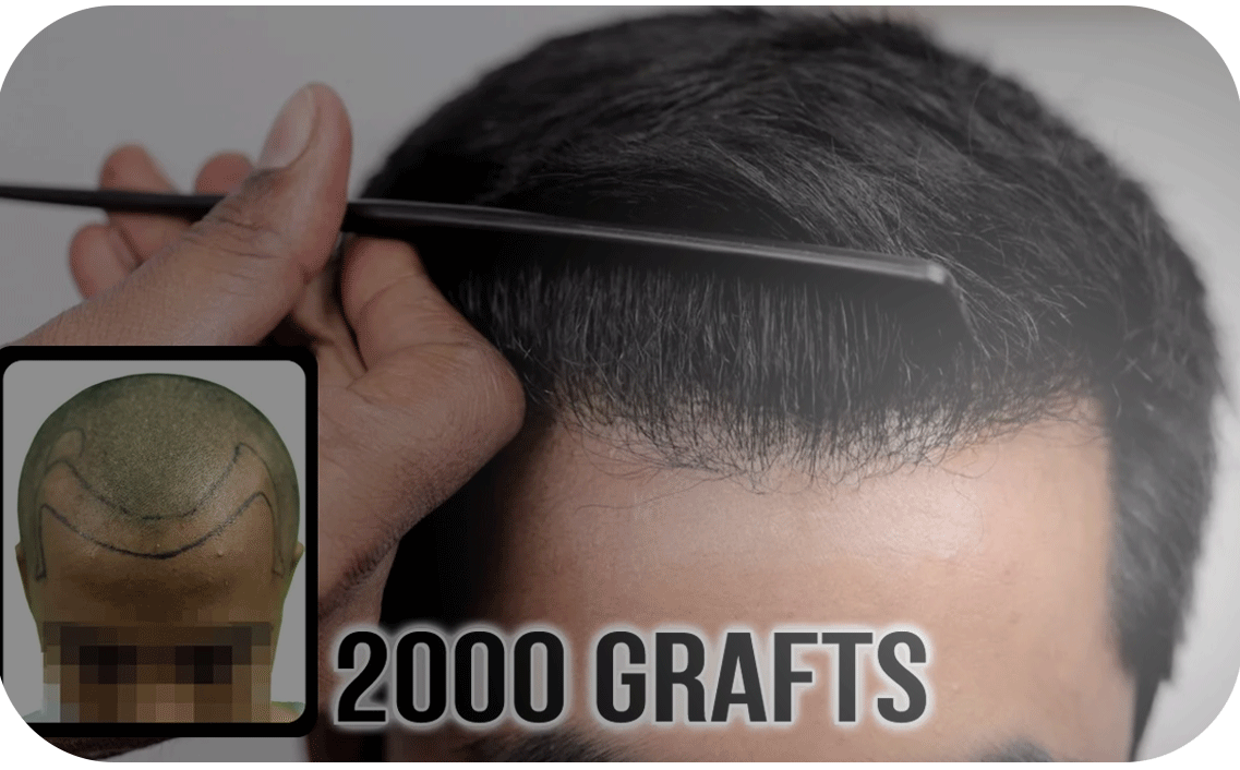 Hair Transplant bangladesh grade 1