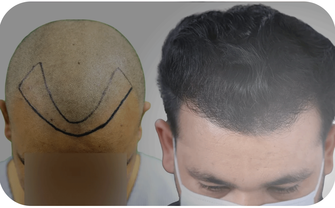 Hair Transplant bangladesh grade 2