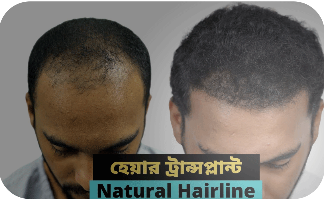 Hair Transplant bangladesh grade 3