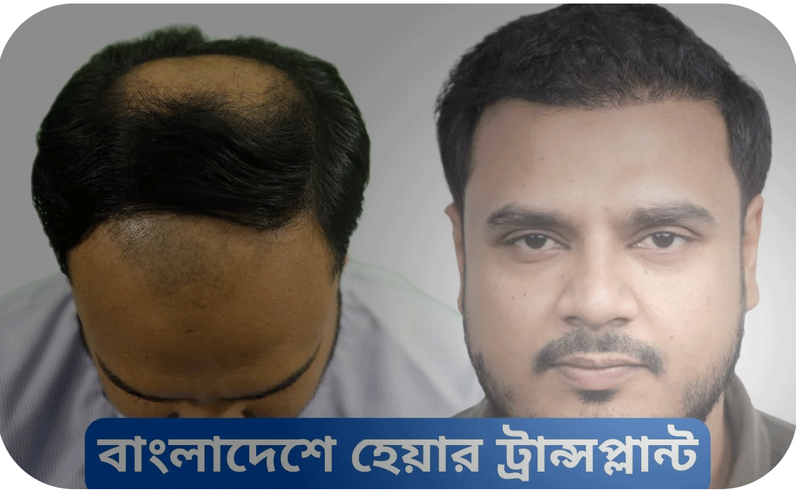 Hair Transplant bangladesh grade 4