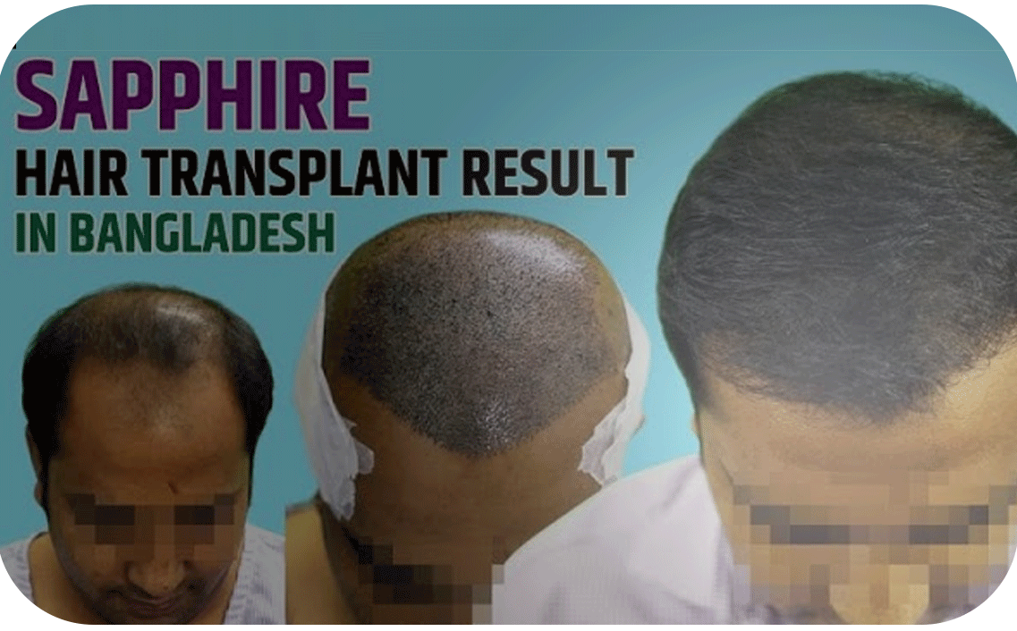 Hair Transplant bangladesh grade 5
