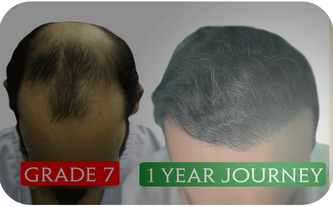 Hair Transplant bangladesh grade 6