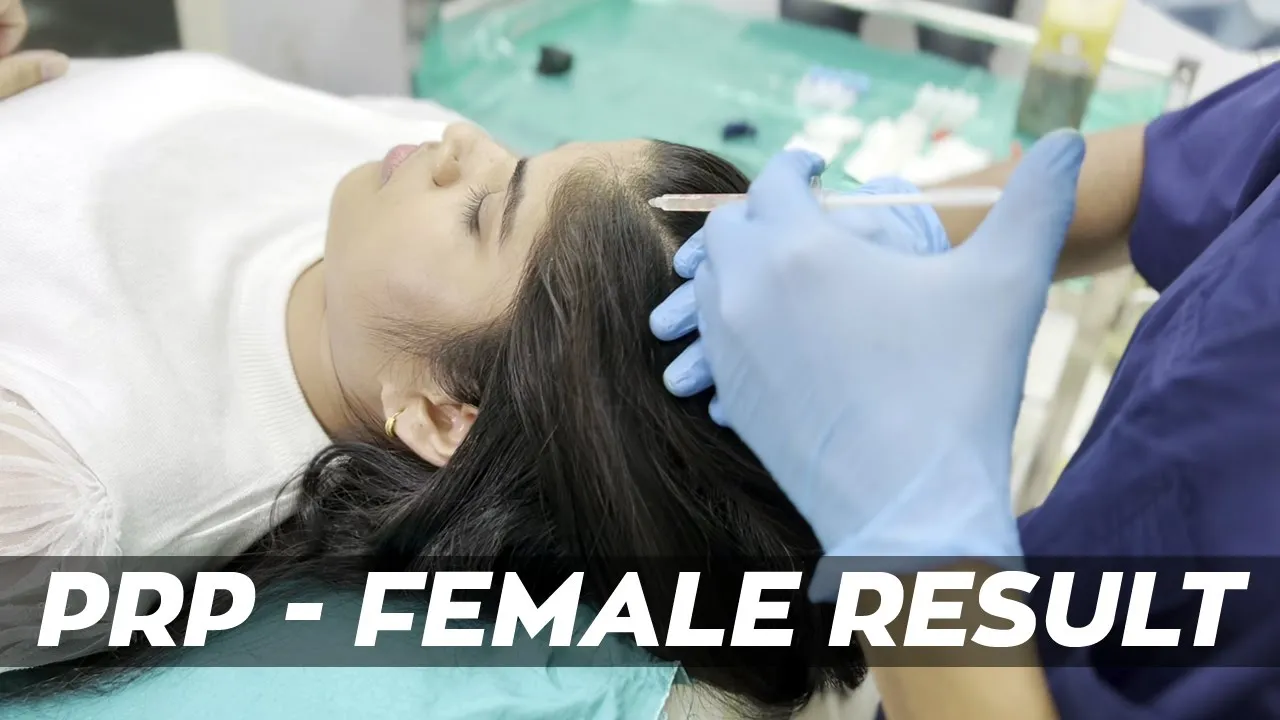 Hair Transplant PRP Female Result