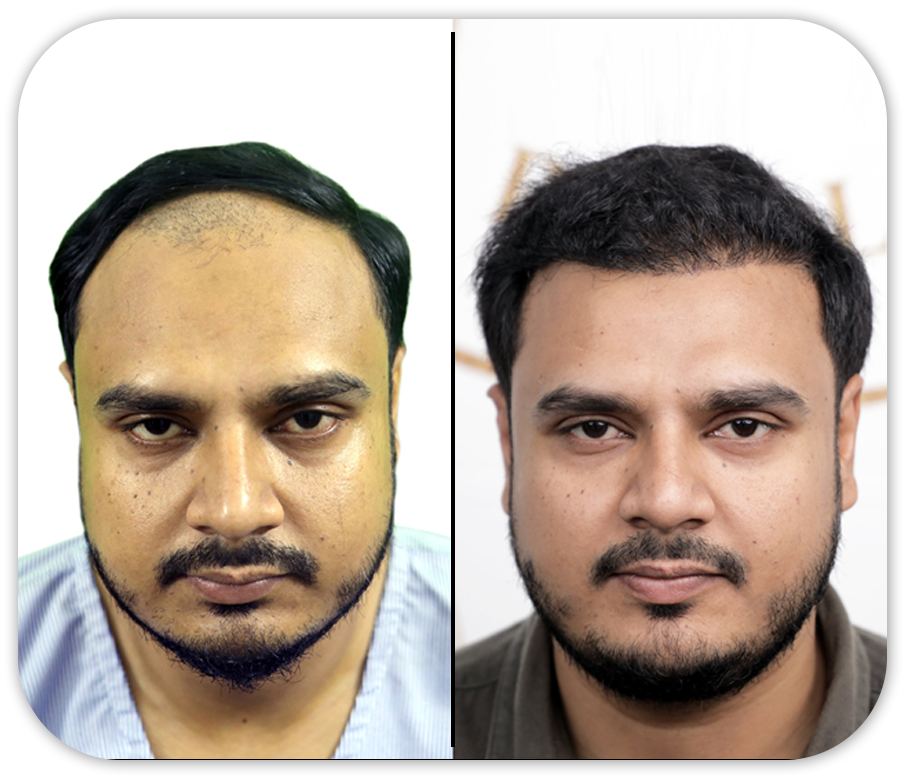 Hair Transplant Before And After Images