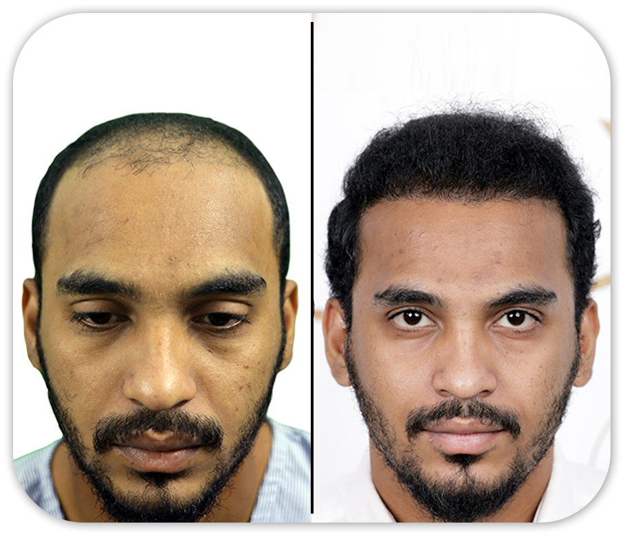 Hair Transplant Before And After Images