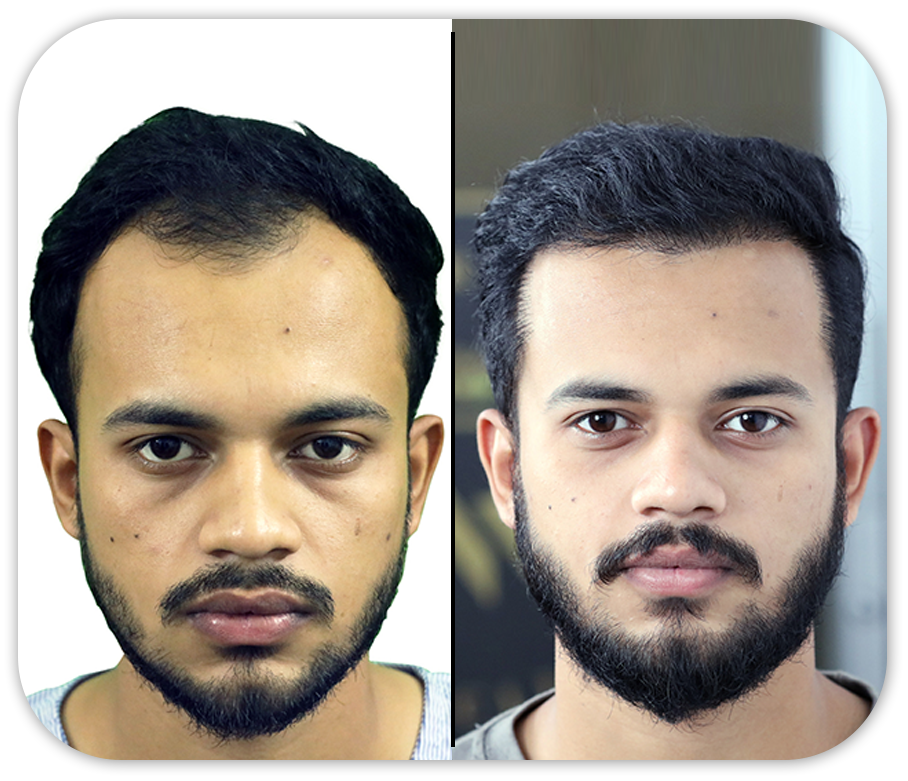 Hair Transplant Before And After Images