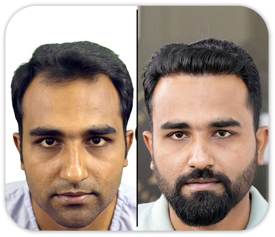 Hair Transplant in Bangladesh, Hair Transplant Cost