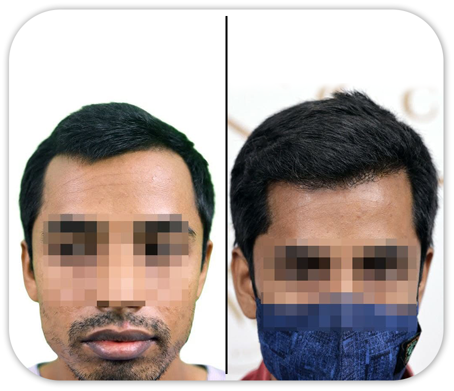 Hair Transplant Before And After Images