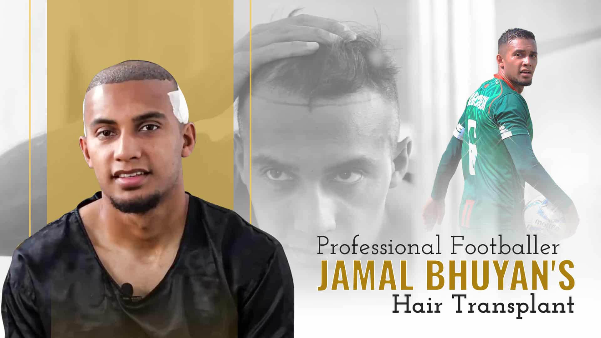 jamal bhuyan hair transplant