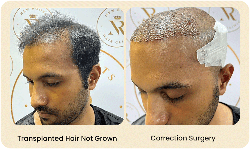 HAIR TRANSPLANT CORRECTION SURGERY Before after Images