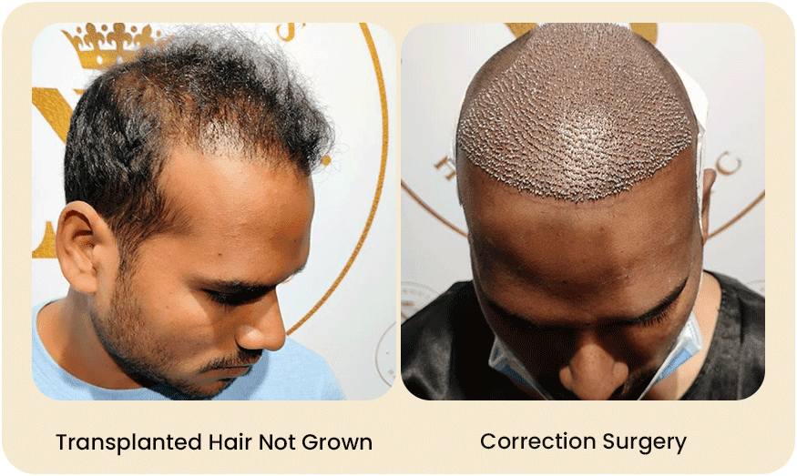 HAIR TRANSPLANT CORRECTION SURGERY Before after Images