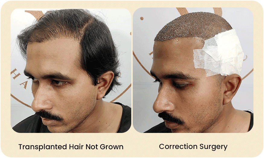 HAIR TRANSPLANT CORRECTION SURGERY Before after Images