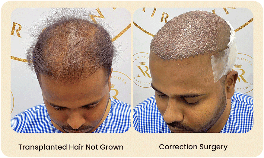 HAIR TRANSPLANT CORRECTION SURGERY Before after Images