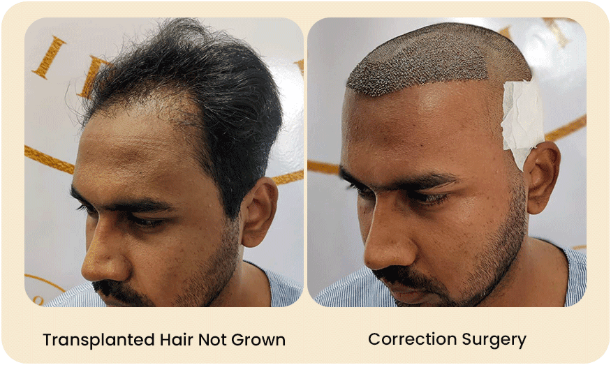 HAIR TRANSPLANT CORRECTION SURGERY Before after Images