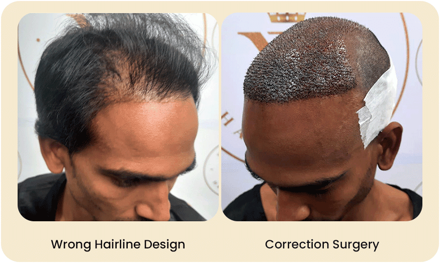 HAIR TRANSPLANT CORRECTION SURGERY Before after Images