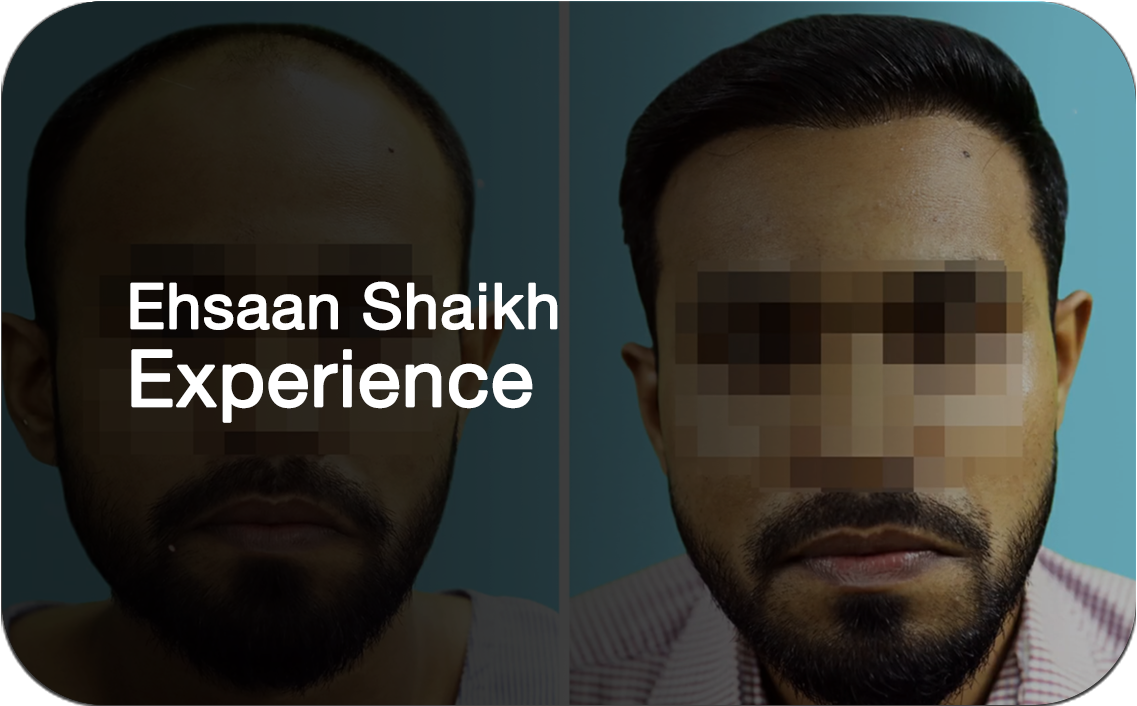 Ehsaan Shaikh Hair Transplant